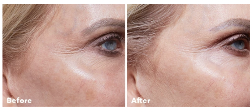 The AnteAGE Home Microneedling Solution Kit helps to reduce fine lines to bring a more youthful complexion to the skin